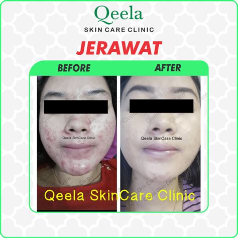 5+ Perawatan Wajib di Alzena: Harga Mulai Rp99 Ribu? 5+ Perawatan Wajib di Alzena: Harga Mulai Rp99 Ribu?