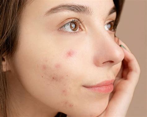 5 Tips Sederhana Atasi Jerawat, Wajah Bercahaya ala Influencer! 5 Tips Sederhana Atasi Jerawat, Wajah Bercahaya ala Influencer!