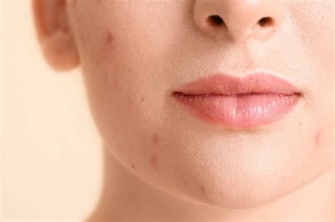 5 Tips Sederhana Atasi Jerawat, Wajah Bercahaya ala Influencer! 5 Tips Sederhana Atasi Jerawat, Wajah Bercahaya ala Influencer!