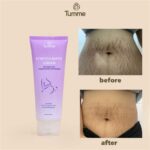 7 Cara Ampuh Menyamarkan Stretch Mark Membandel!