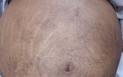 7 Cara Ampuh Menyamarkan Stretch Mark Membandel! 7 Cara Ampuh Menyamarkan Stretch Mark Membandel!