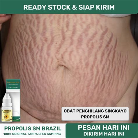 7 Cara Ampuh Menyamarkan Stretch Mark Membandel! 7 Cara Ampuh Menyamarkan Stretch Mark Membandel!