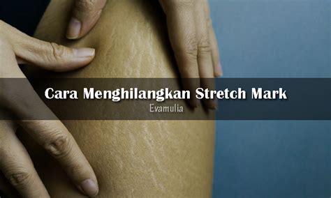 7 Cara Ampuh Menyamarkan Stretch Mark Membandel! 7 Cara Ampuh Menyamarkan Stretch Mark Membandel!