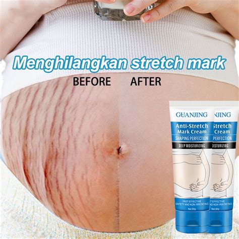 7 Cara Ampuh Menyamarkan Stretch Mark Membandel! 7 Cara Ampuh Menyamarkan Stretch Mark Membandel!