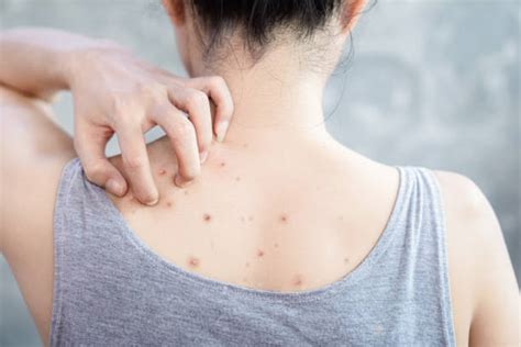 7 Cara Efektif Menghilangkan Jerawat di Punggung yang Bisa Kamu Coba di Rumah! 7 Cara Efektif Menghilangkan Jerawat di Punggung yang Bisa Kamu Coba di Rumah!