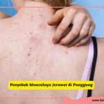 7 Cara Efektif Menghilangkan Jerawat di Punggung yang Bisa Kamu Coba di Rumah!
