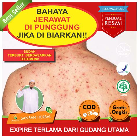 7 Cara Efektif Menghilangkan Jerawat di Punggung yang Bisa Kamu Coba di Rumah! 7 Cara Efektif Menghilangkan Jerawat di Punggung yang Bisa Kamu Coba di Rumah!