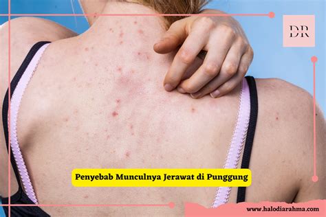 7 Cara Efektif Menghilangkan Jerawat di Punggung yang Bisa Kamu Coba di Rumah! 7 Cara Efektif Menghilangkan Jerawat di Punggung yang Bisa Kamu Coba di Rumah!