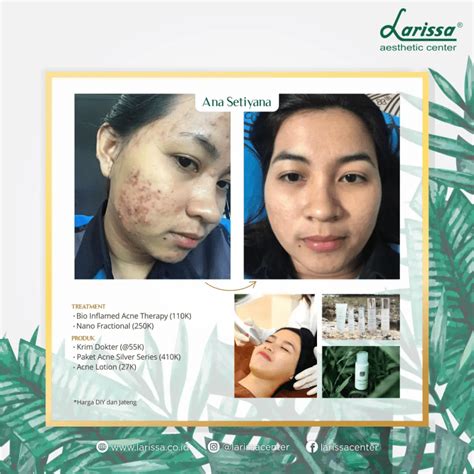 7 Perawatan Larissa di Bawah 50 Ribu! Rahasia Glowing Tanpa Bokek? 7 Perawatan Larissa di Bawah 50 Ribu! Rahasia Glowing Tanpa Bokek?