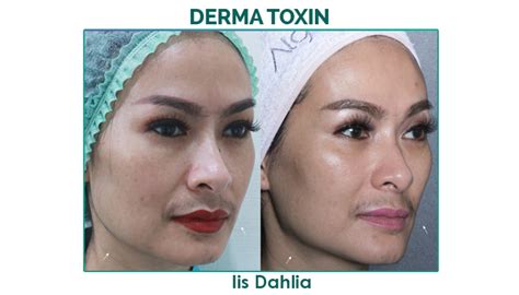 7 Rahasia Kulit Glowing ala Bening's Clinic: Treatment yang Wajib Kamu Coba! 7 Rahasia Kulit Glowing ala Bening's Clinic: Treatment yang Wajib Kamu Coba!