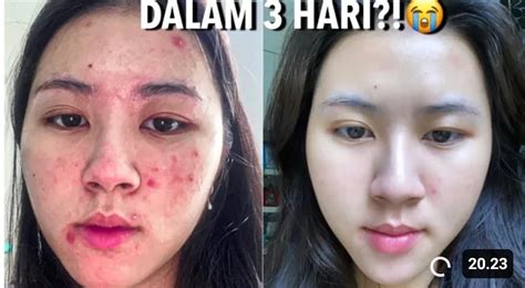7 Rahasia Perawatan Kulit Berjerawat dan Berminyak untuk Menghasilkan Wajah Glowing dalam 1 Minggu! 7 Rahasia Perawatan Kulit Berjerawat dan Berminyak untuk Menghasilkan Wajah Glowing dalam 1 Minggu!