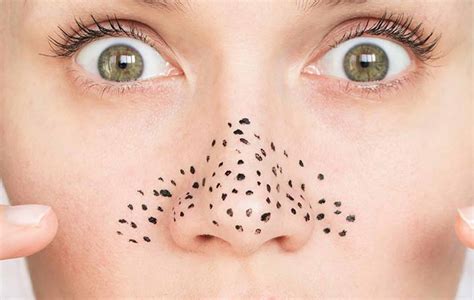 7 Treatment Ampuh Basmi Komedo Membandel, Nomor 5 Bikin Kaget! 7 Treatment Ampuh Basmi Komedo Membandel, Nomor 5 Bikin Kaget!