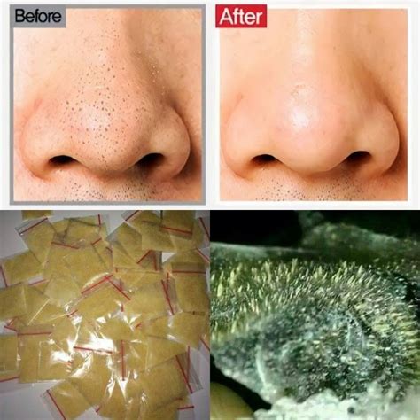 7 Treatment Ampuh Basmi Komedo Membandel, Nomor 5 Bikin Kaget!