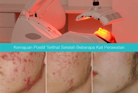 7 Treatment Estetiderma di Bawah 1 Juta yang Bikin Glowing Instan! 7 Treatment Estetiderma di Bawah 1 Juta yang Bikin Glowing Instan!