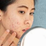 7 Treatment Jerawat Membandel di Bawah 500 Ribu, Bye Wajah Breakout!