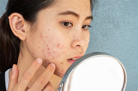 7 Treatment Jerawat Membandel di Bawah 500 Ribu, Bye Wajah Breakout!
