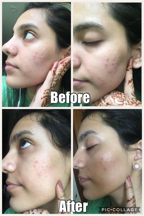 5 Skincare Goals TerwujudSetelah Dermaroller: Wajah Keren and Radiance level 💫