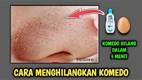 7 Cara Perawatan Wajah untuk Menghilangkan Komedo Secara Alami dan Permanen dalam Waktu Singkat 7 Cara Perawatan Wajah untuk Menghilangkan Komedo Secara Alami dan Permanen dalam Waktu Singkat