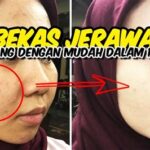 7 Treatment Kulit yang Bisa Menghilangkan Jerawat dan Membuat Wajahmu Bersinar dalam Semalam!