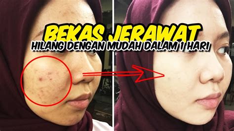 7 Treatment Kulit yang Bisa Menghilangkan Jerawat dan Membuat Wajahmu Bersinar dalam Semalam!